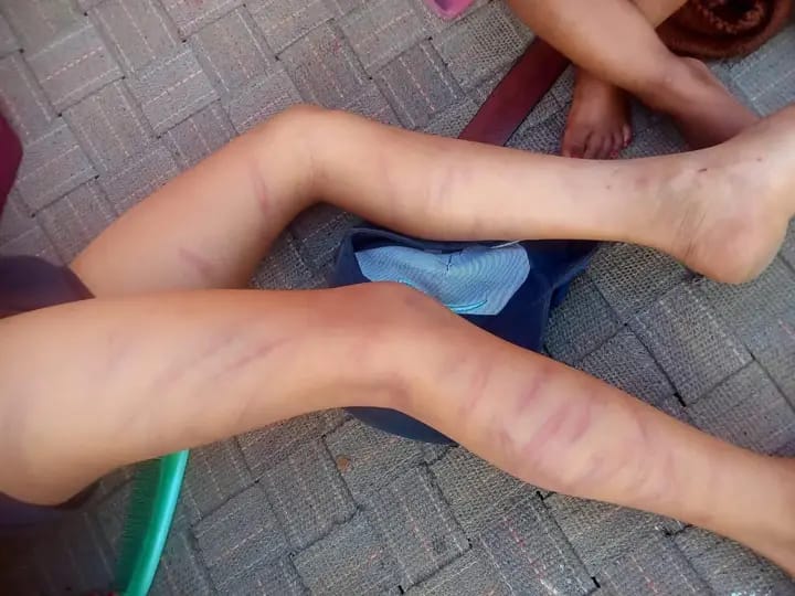 गोंडा : कर्नलगंज में कक्षा 2 के मासूम छात्र को शिक्षक ने गिनकर मारे 105 डंडे, शरीर पर गहरे जख्म